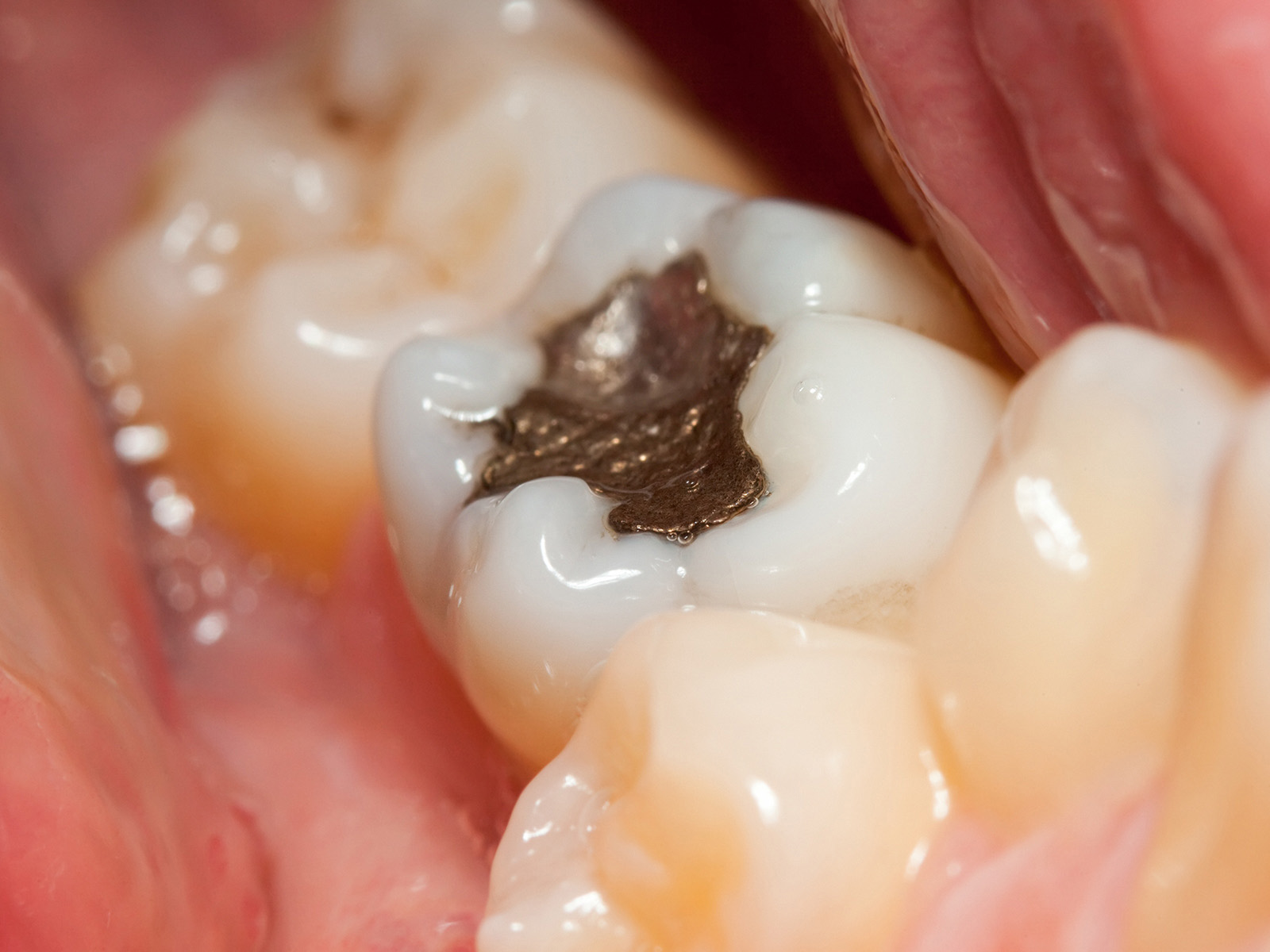 What Are Tooth-Colored Fillings?
