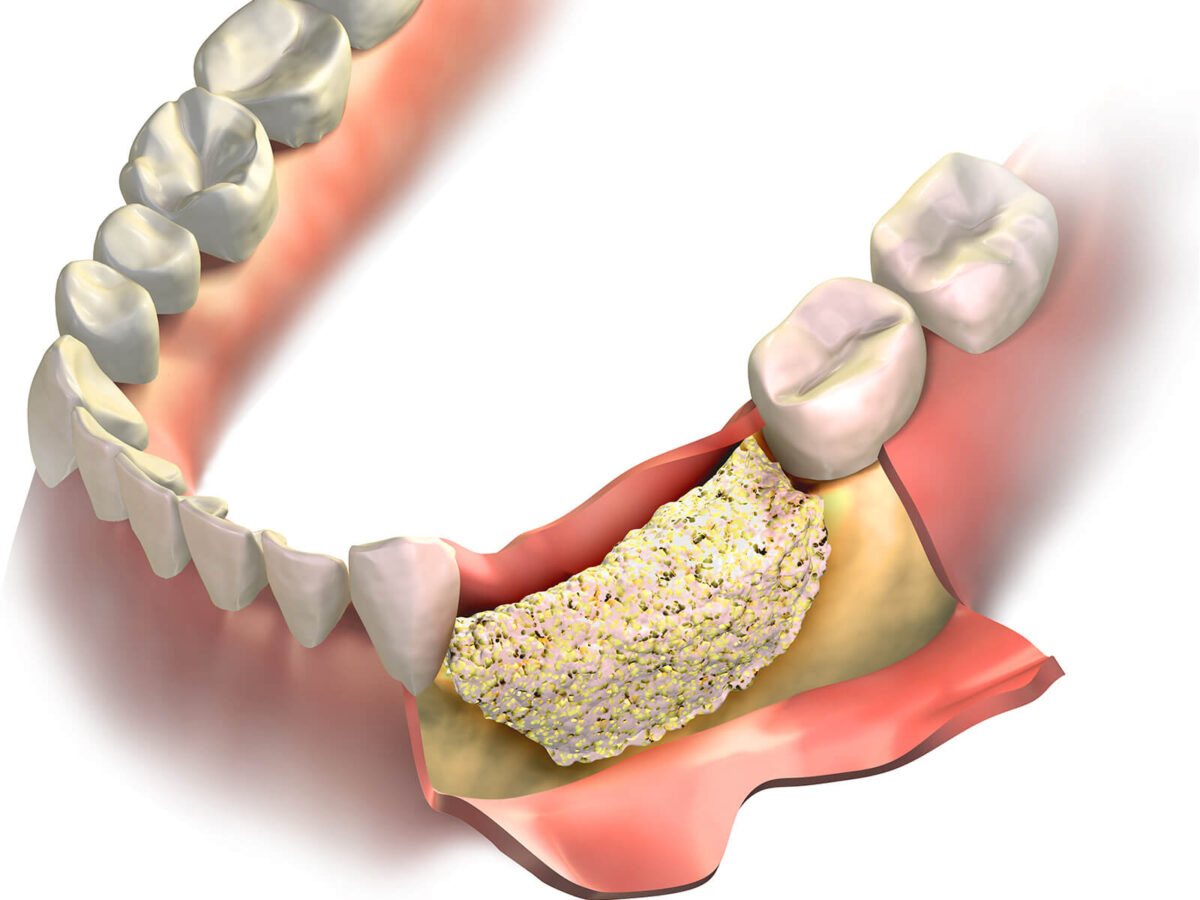 Bone Grafting