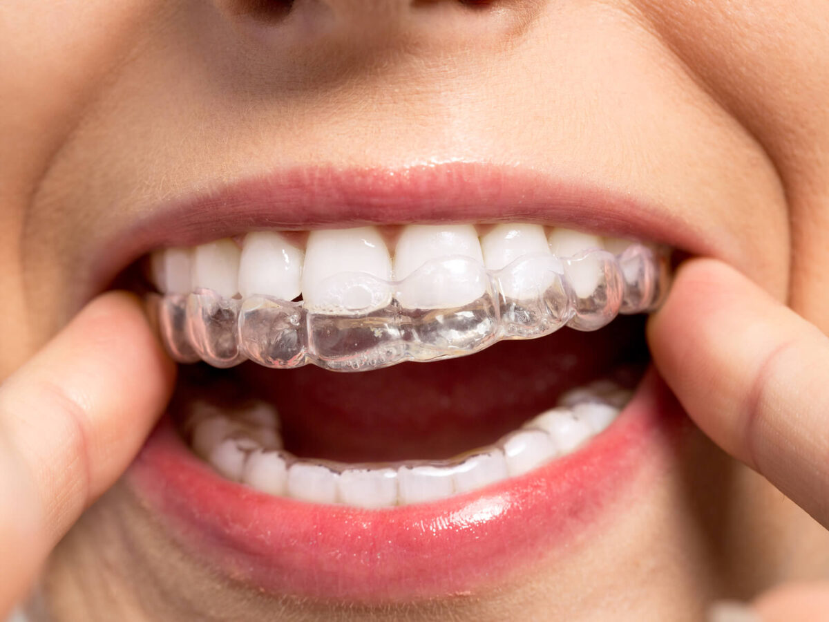 Invisalign For Crowded Teeth