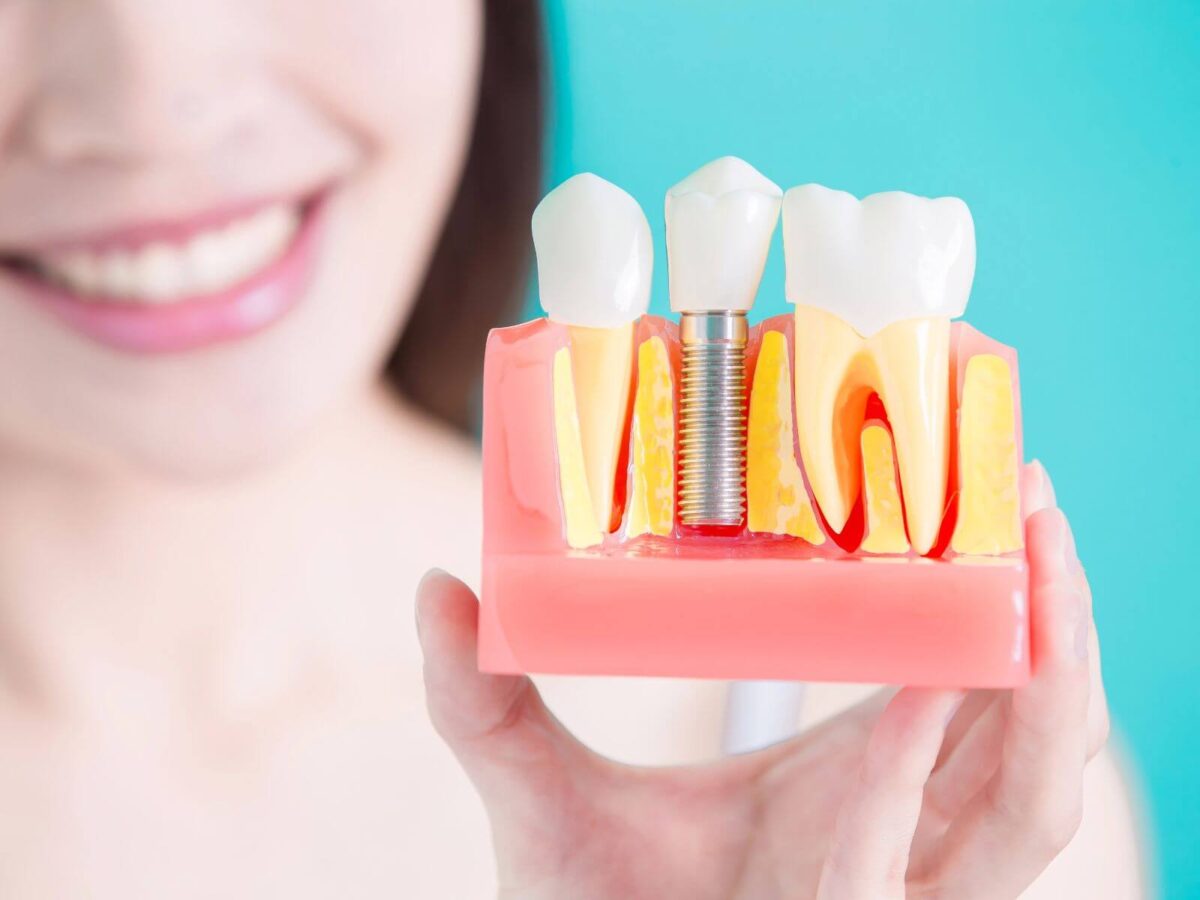 How Many Implants Are Needed For Implant-Supported Dentures?