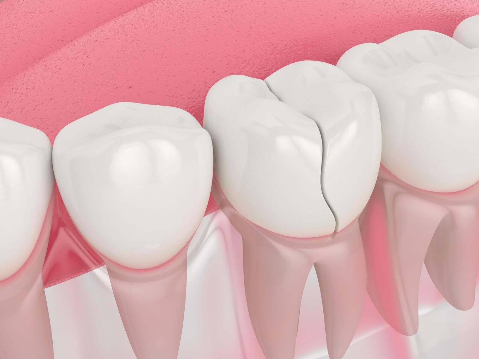 Cracked Tooth Pain – Helpful Guide To Manage The Condition