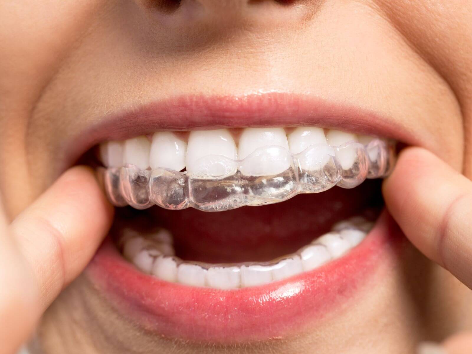 How Orthodontic Services Like Invisalign Can Transform Your Smile