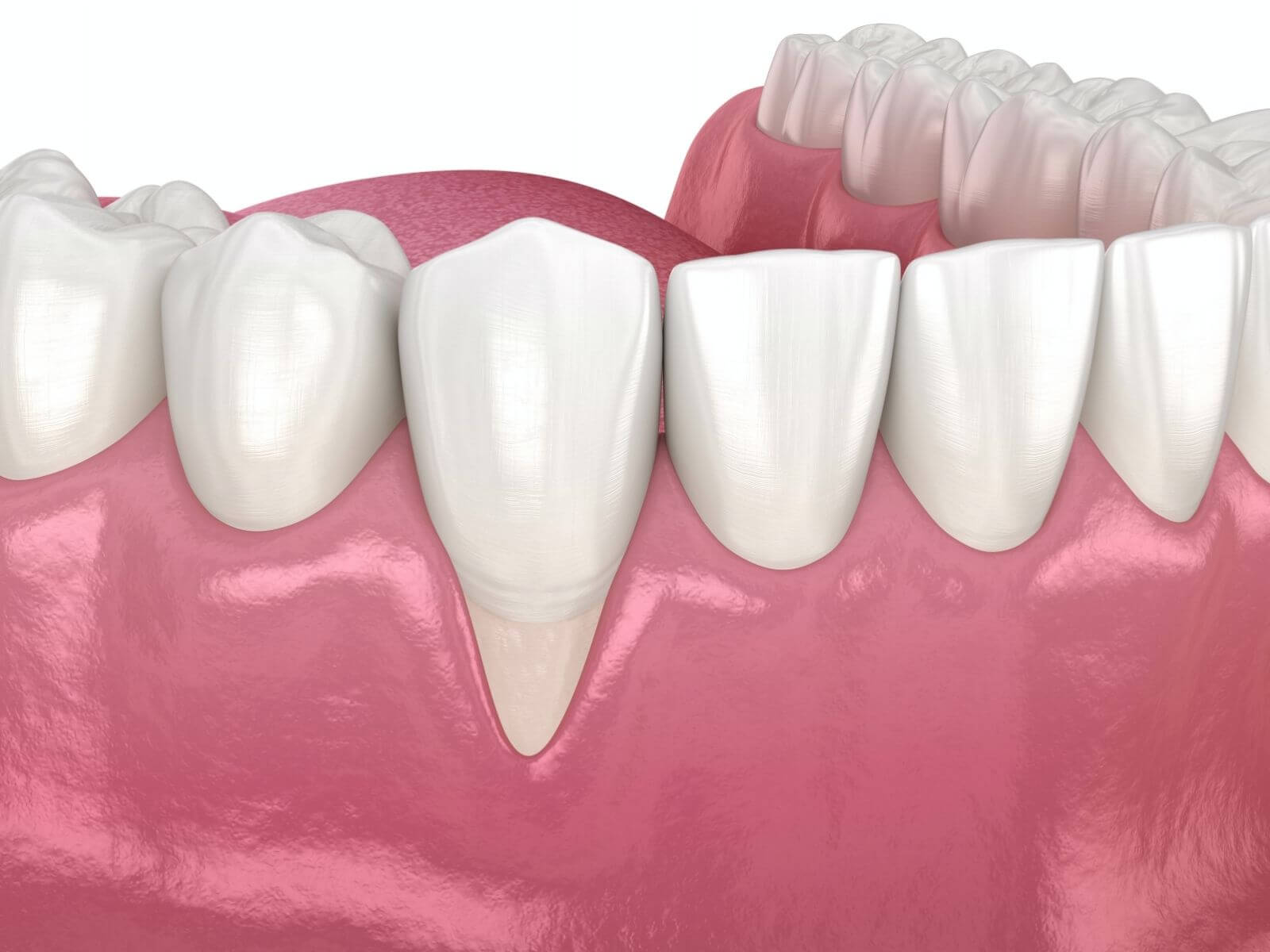 How To Identify Early Signs of Gum Recession